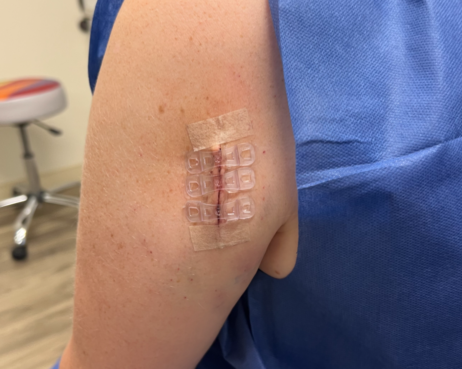 Lipoma Removal with Brijjit Before, 4 Months Post-Op, Dr. Andrew Cohen