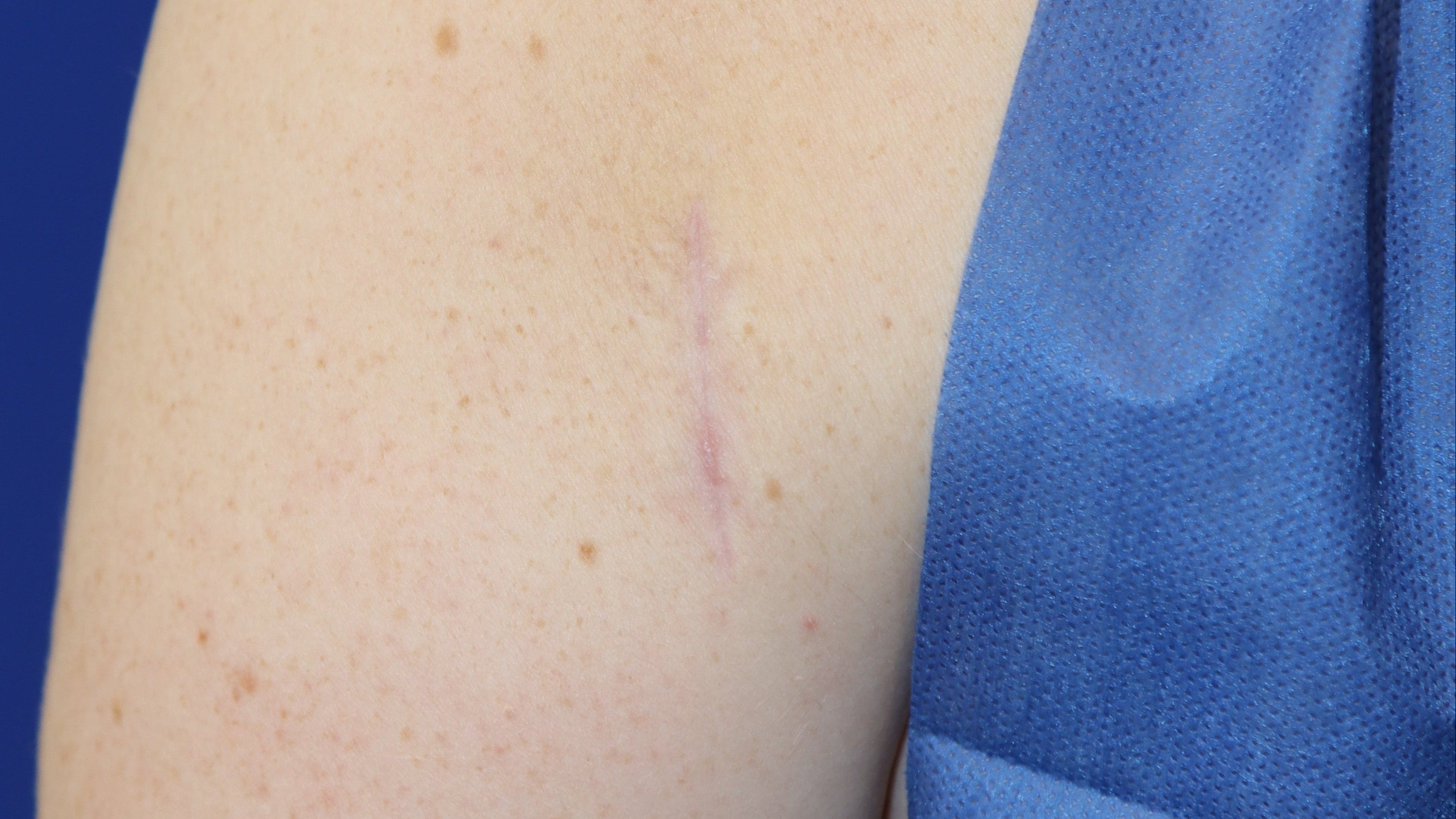 Lipoma Removal with Brijjit Scar Outcome, 4 Months Post-Op, Dr. Andrew Cohen