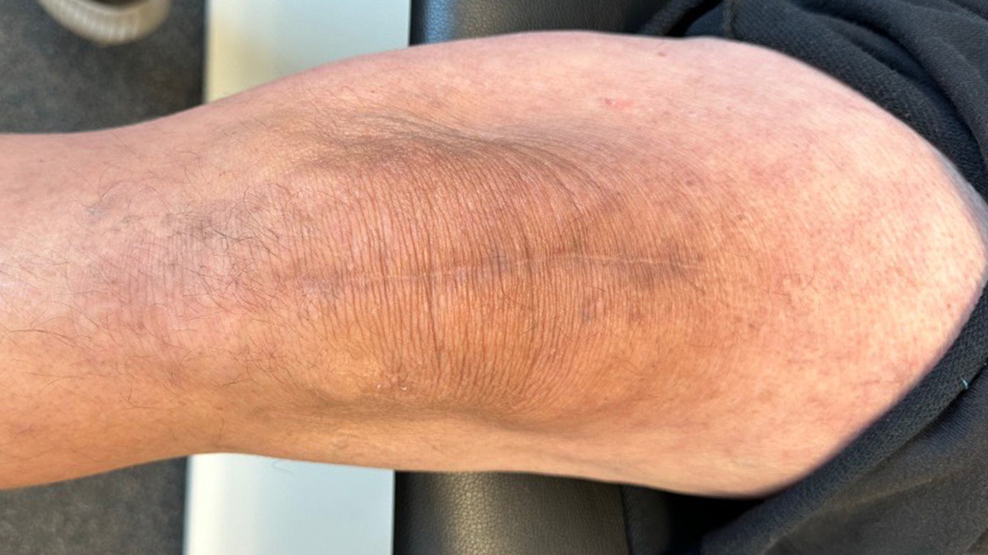 Quad Tendon Repair Using Brijjit, Scar is 5 Months Post-Op, Dr. Andy Grotting