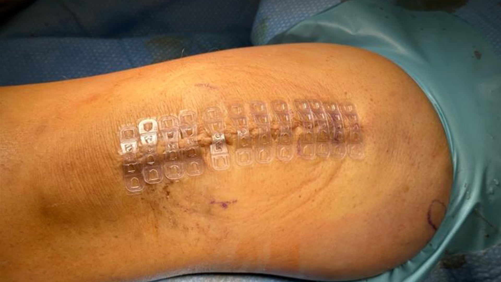 Quad Tendon Repair Using Brijjit, Scar is 5 Months Post-Op, Dr. Andy Grotting