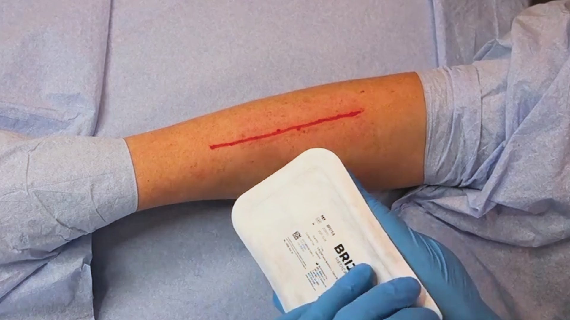Load video: How to apply Brijjit Force Modulating Tissue Bridges