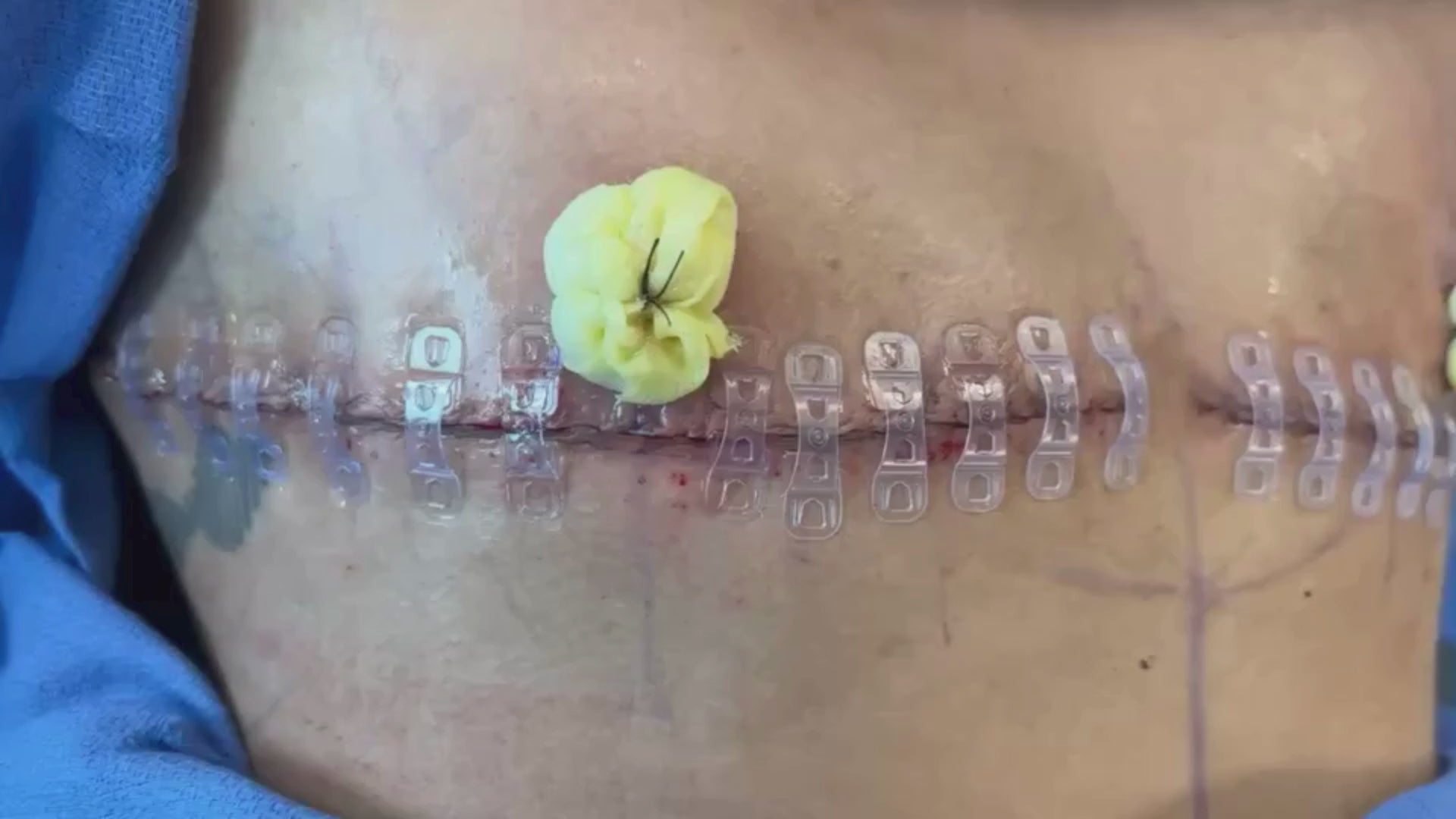 Load video: Top Surgery