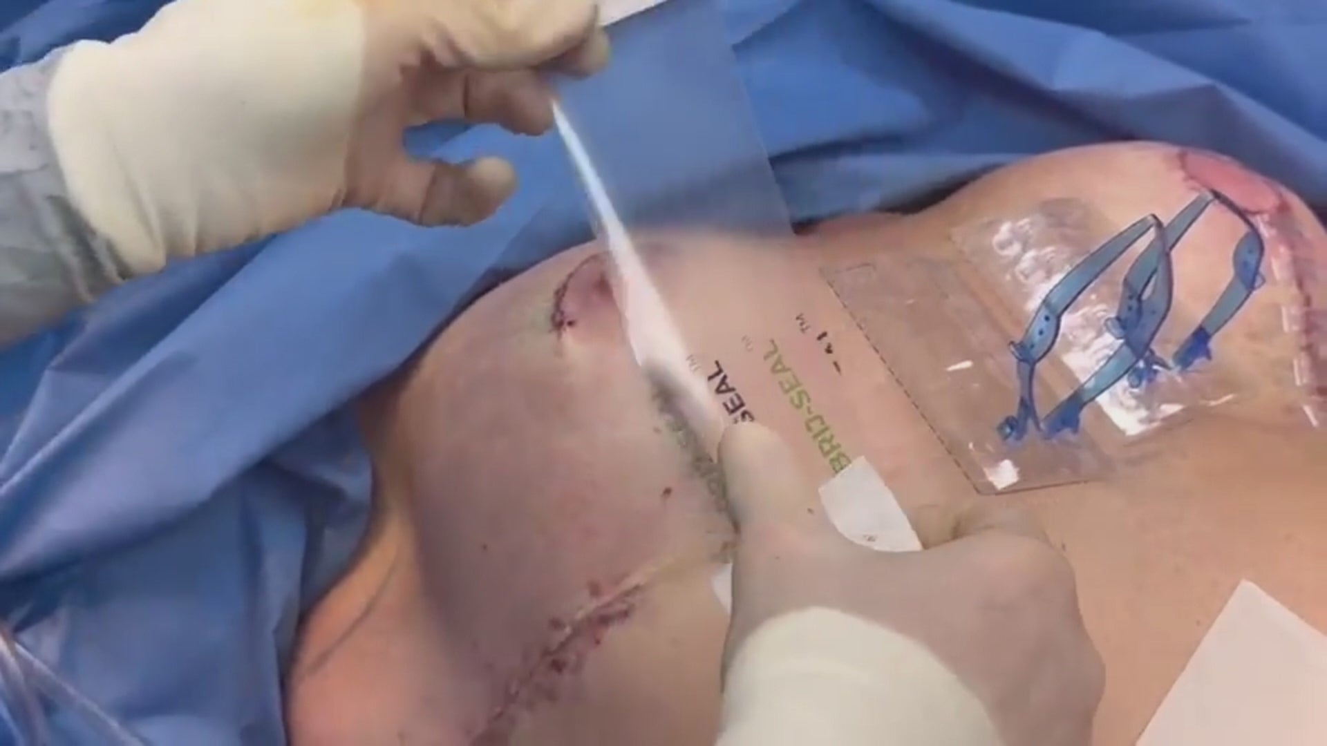 Load video: Plastic surgeon places Brijjit, a final skin closure device, to reduce wound dehiscence, wound breakdown and end with smaller scars in hip surgery.