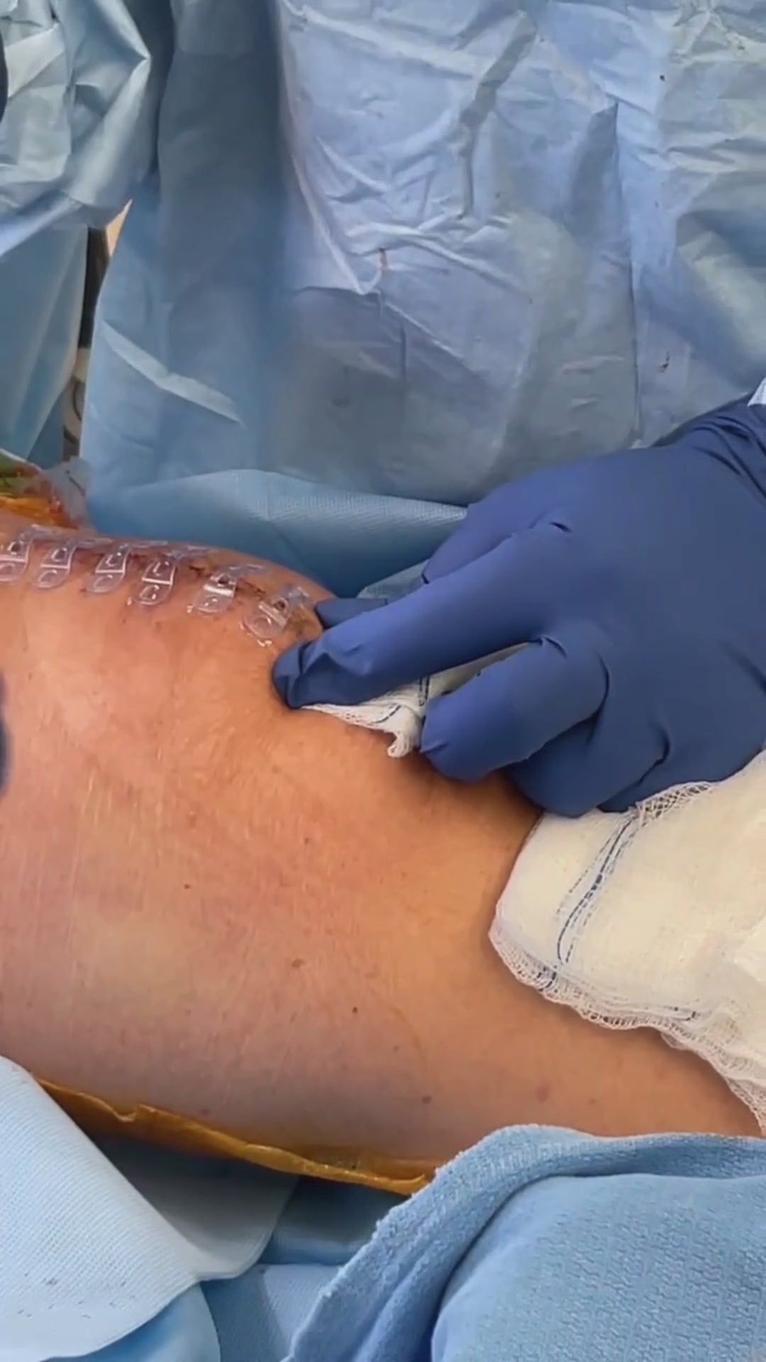 Load video: Plastic surgeon places Brijjit, a final skin closure device, to reduce wound dehiscence, wound breakdown and end with smaller scars in knee surgery.