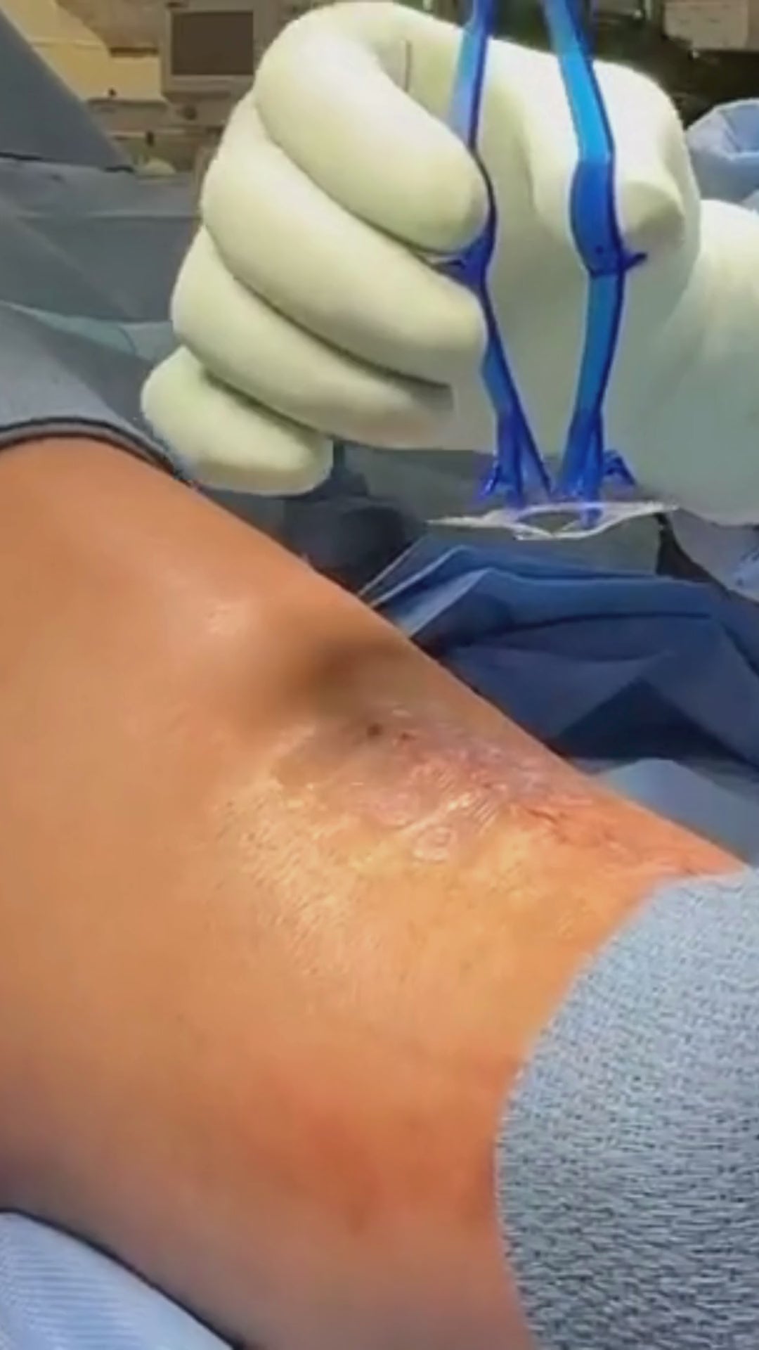 Load video: Plastic surgeon places Brijjit, a final skin closure device, to reduce wound dehiscence, wound breakdown and end with smaller scars in foot and ankle surgery.