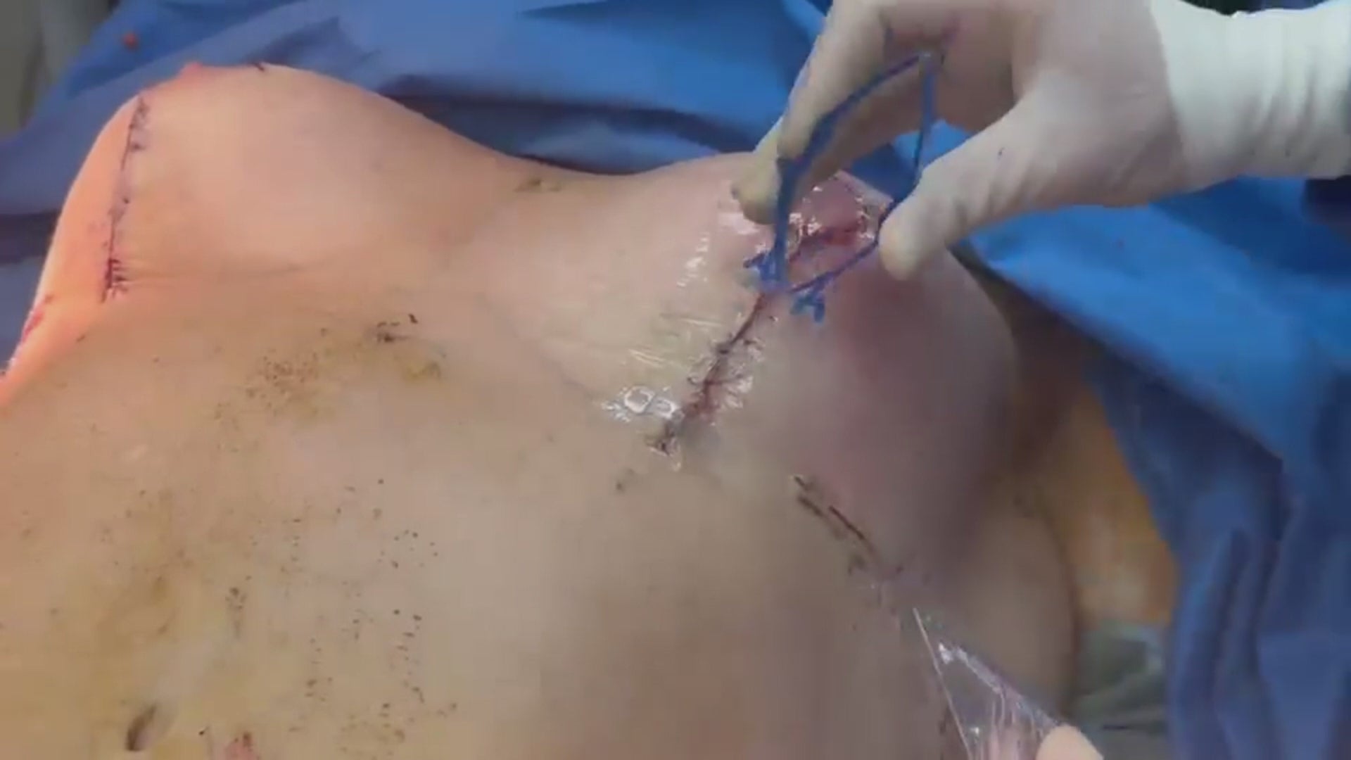 Load video: Surgeon uses active tension offloading device, Brijjit, to prevent wound dehiscence, reduce wound breakdown, and leave smaller scars after orthopedic and plastic surgery.