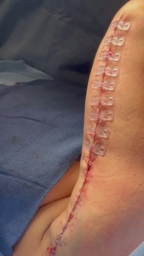 Load video: Plastic surgeon places Brijjit, a final skin closure device, to reduce wound dehiscence, wound breakdown and end with smaller scars in arm surgery.