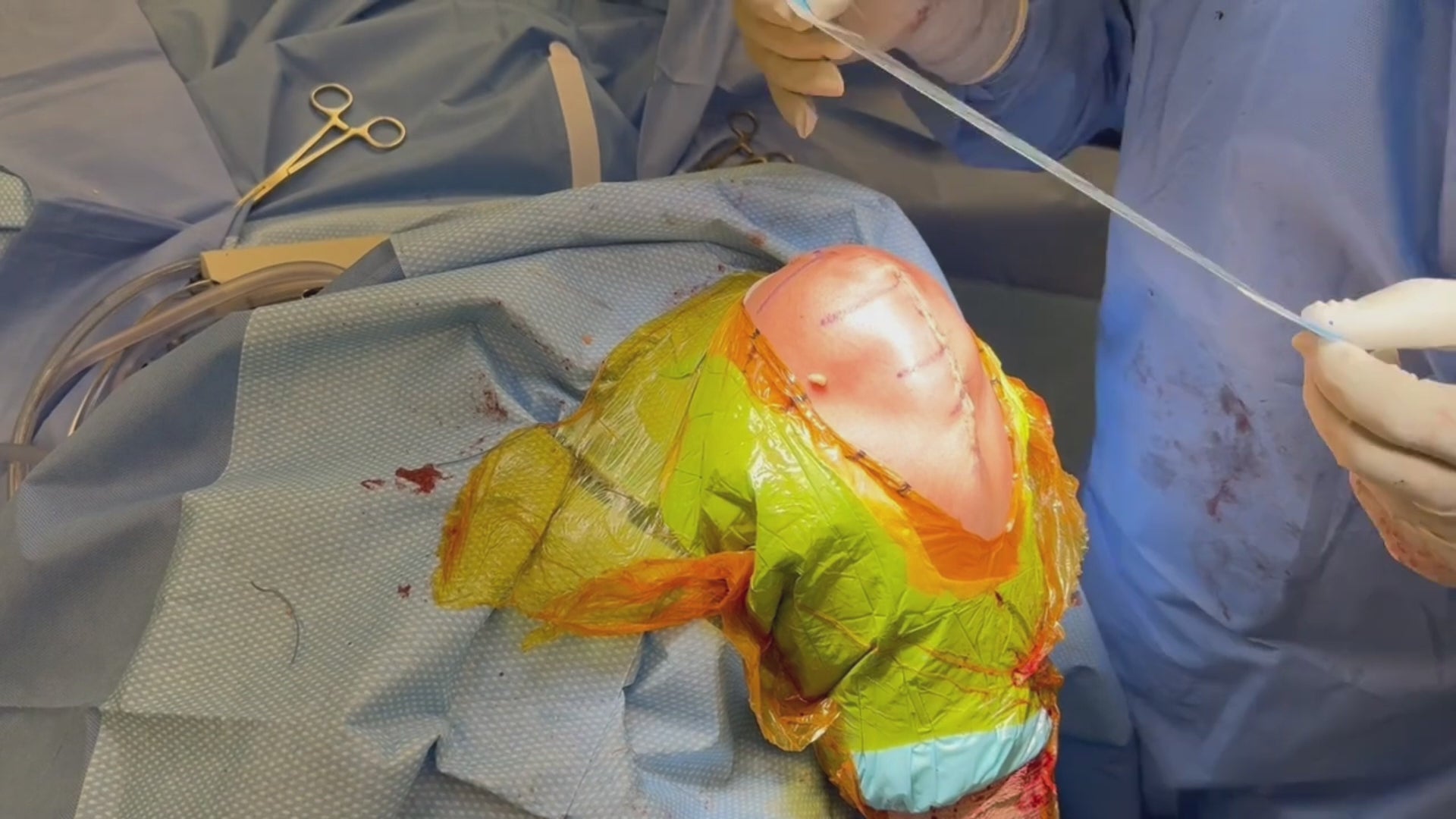 Load video: Active tension offloading device, Brijjit, is used to prevent wound dehiscence, wound breakdown, and leave smaller scars in plastics and orthopedic surgery.