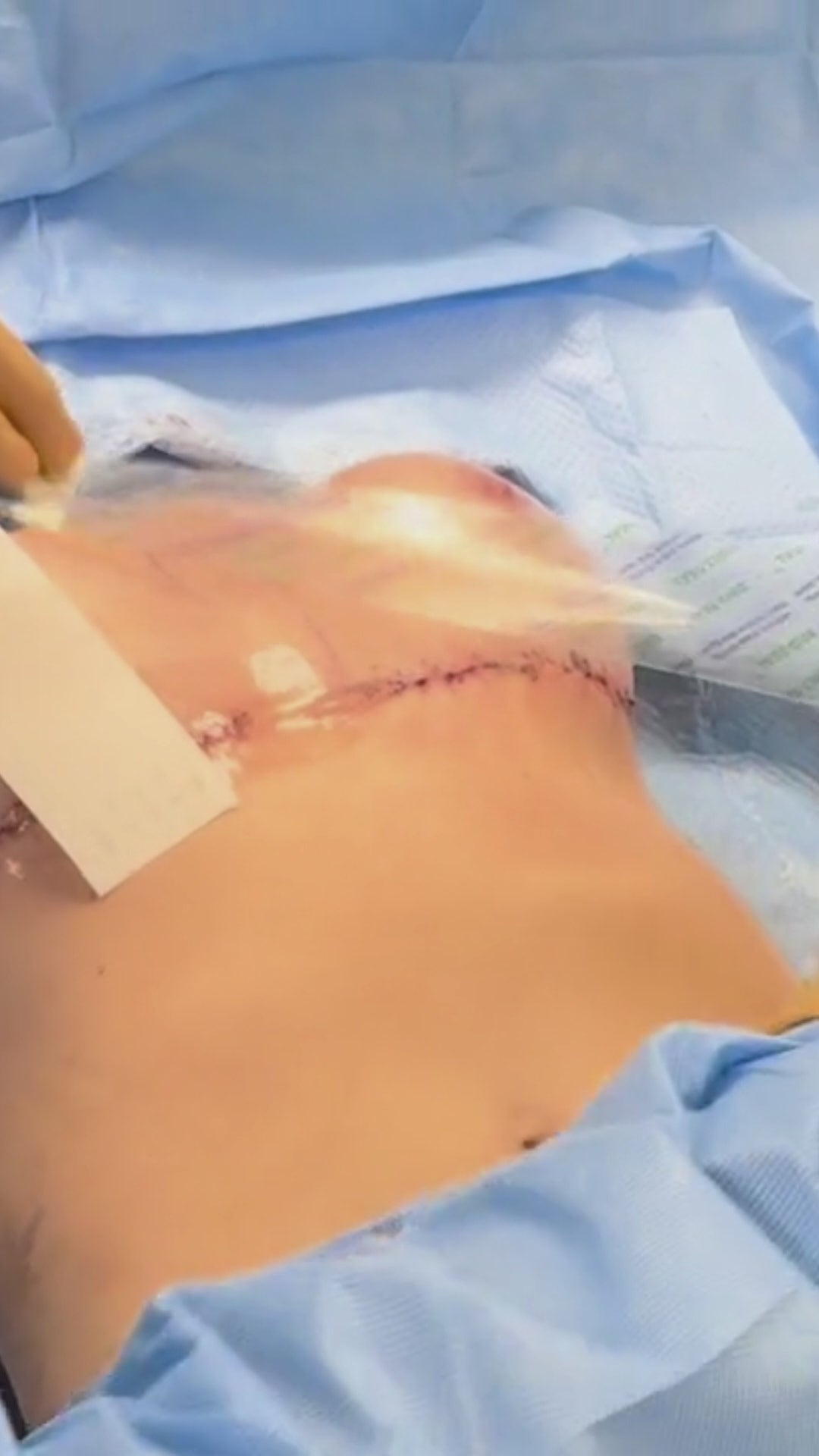 Load video: Plastic surgeon places Brijjit, a final skin closure device, to reduce wound dehiscence, wound breakdown and end with smaller scars in breast surgery.
