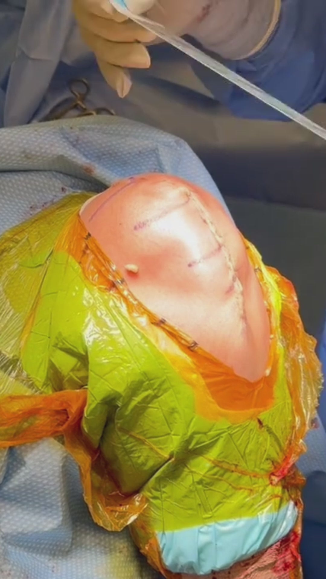 Load video: Active tension offloading device, Brijjit, is used to prevent wound dehiscence, wound breakdown, and leave smaller scars in plastics and orthopedic surgery.