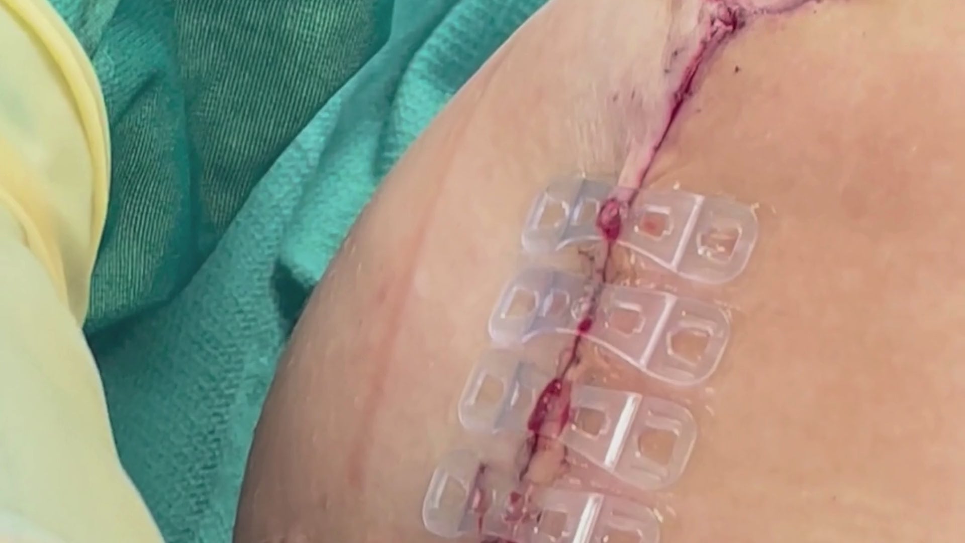 Load video: Plastic surgeon places Brijjit, a final skin closure device, to reduce wound dehiscence, wound breakdown and end with smaller scars in breast surgery.