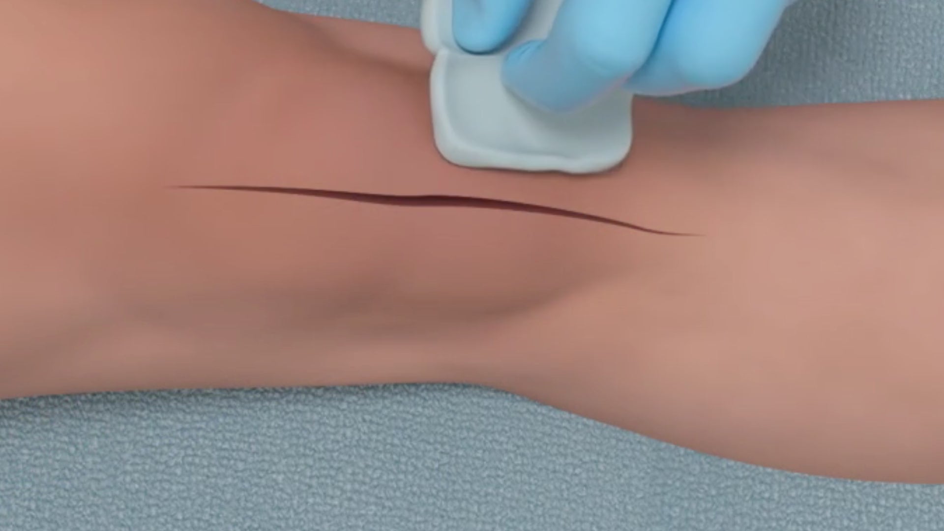 Load video: How to apply Brijjit Force Modulating Tissue Bridges