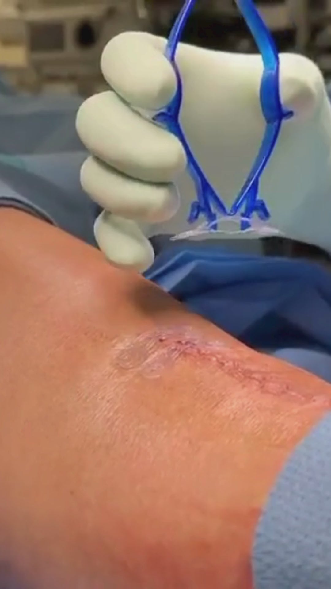 Load video: Surgeon uses active tension offloading device, Brijjit, to prevent wound dehiscence, reduce wound breakdown, and leave smaller scars after orthopedic and plastic surgery.