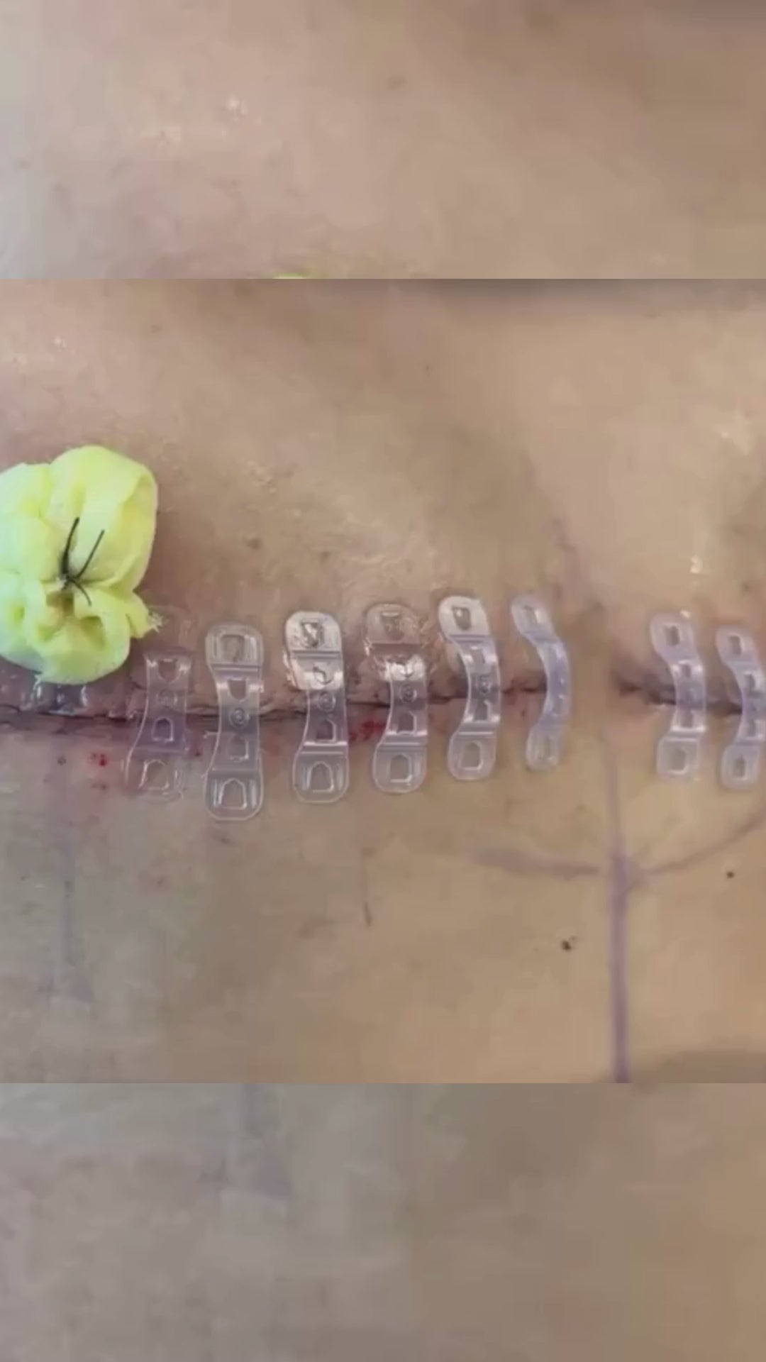 Load video: Top Surgery