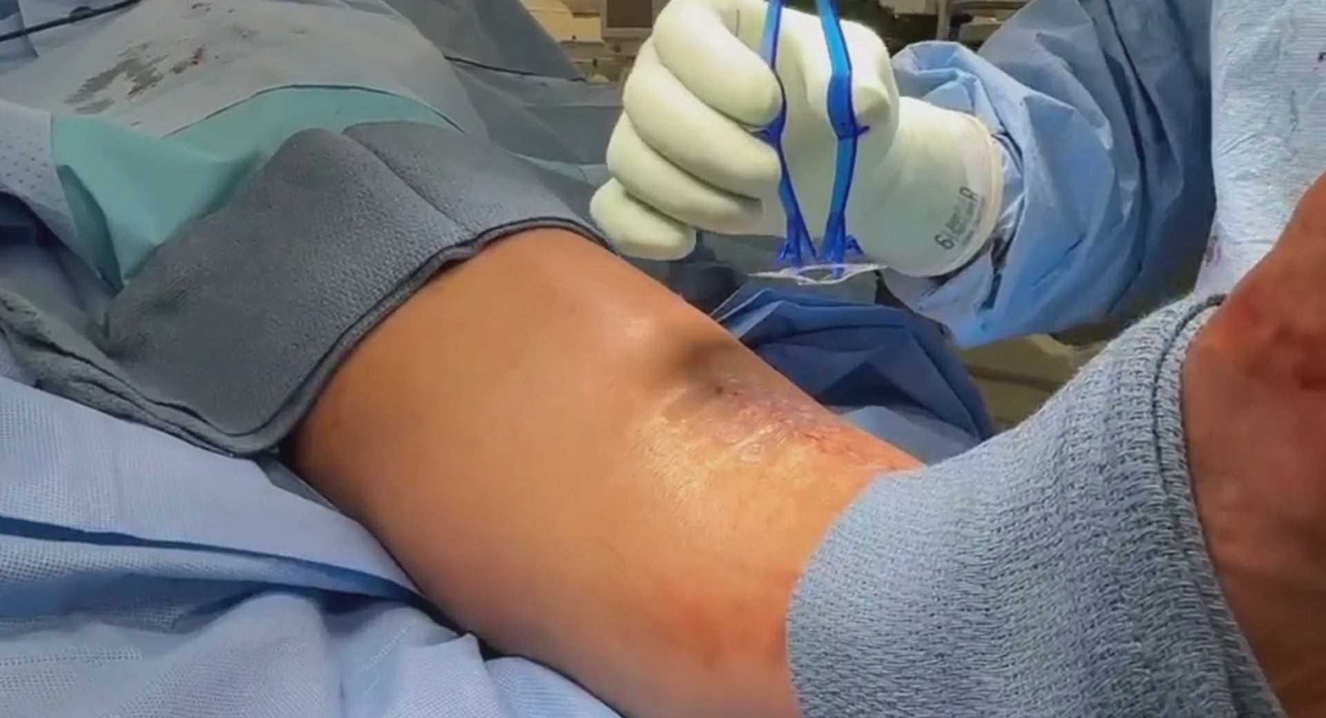 Load video: Plastic surgeon places Brijjit, a final skin closure device, to reduce wound dehiscence, wound breakdown and end with smaller scars in foot and ankle surgery.