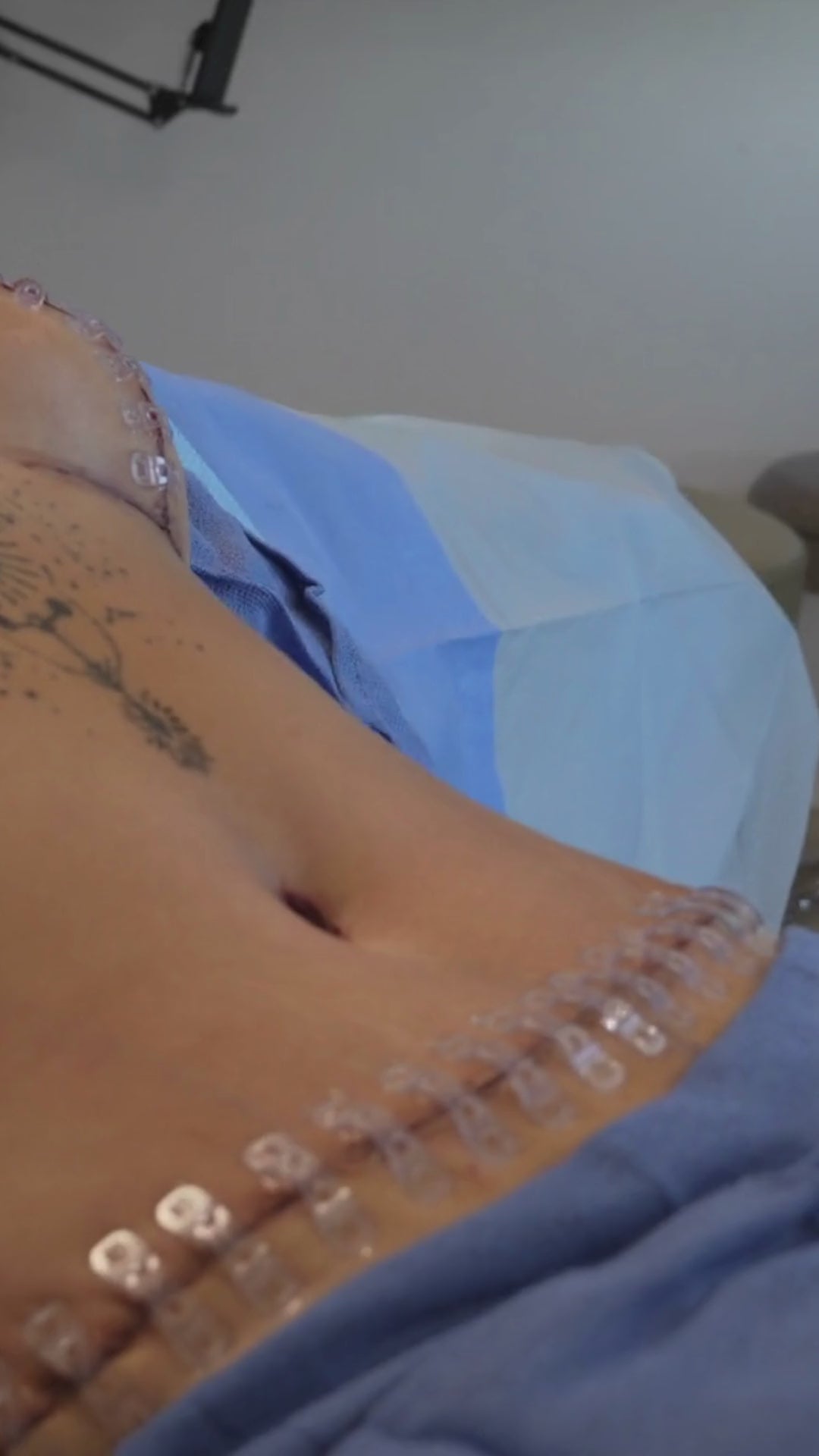 Load video: Breast + Tummy Tuck