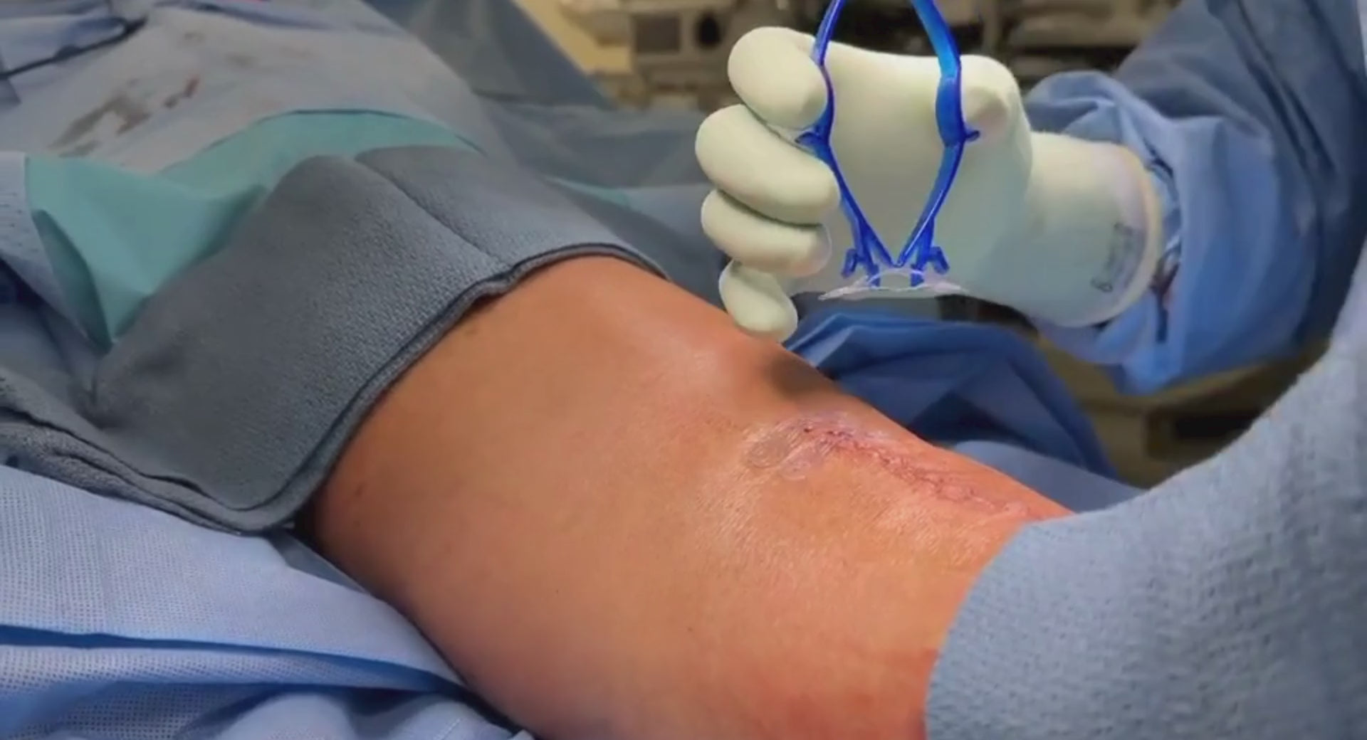 Load video: Surgeon uses active tension offloading device, Brijjit, to prevent wound dehiscence, reduce wound breakdown, and leave smaller scars after orthopedic and plastic surgery.