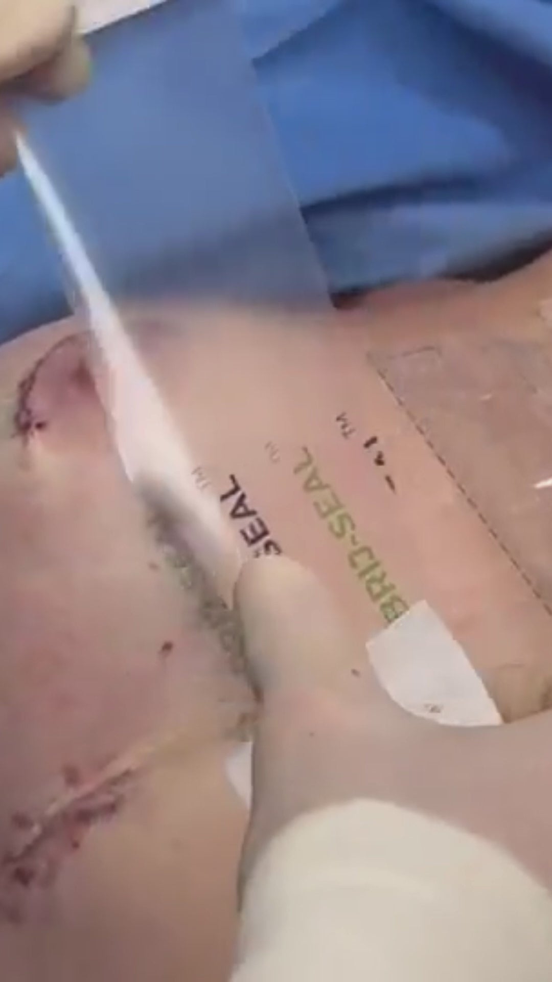 Load video: Plastic surgeon places Brijjit, a final skin closure device, to reduce wound dehiscence, wound breakdown and end with smaller scars in hip surgery.