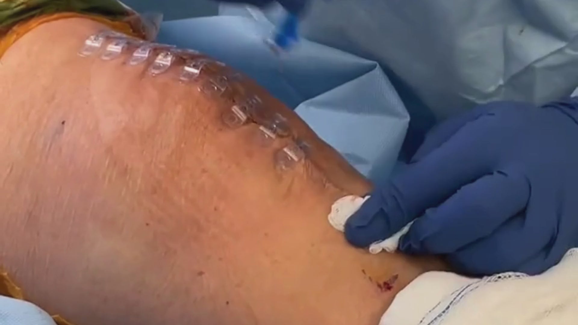 Load video: Plastic surgeon places Brijjit, a final skin closure device, to reduce wound dehiscence, wound breakdown and end with smaller scars in knee surgery.