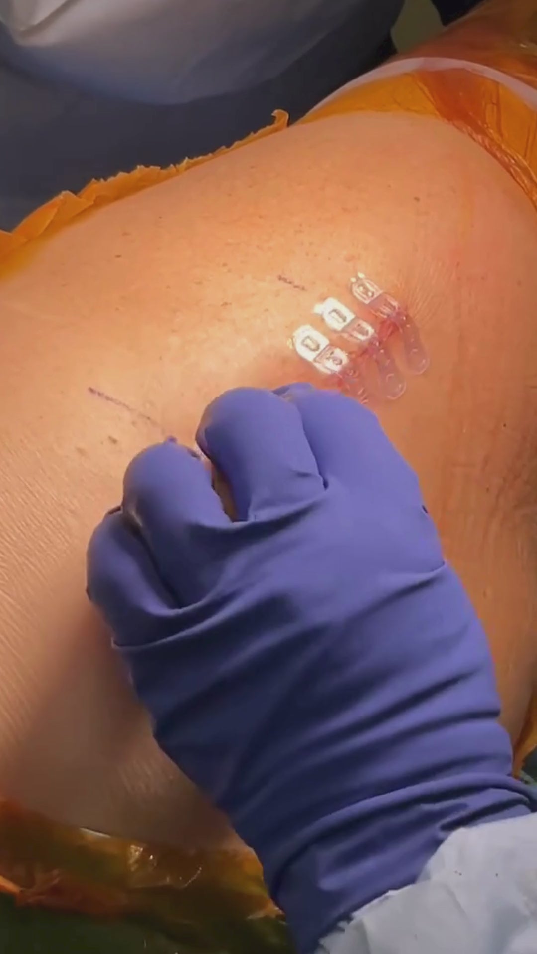 Load video: Plastic surgeon places Brijjit, a final skin closure device, to reduce wound dehiscence, wound breakdown and end with smaller scars in hip surgery.
