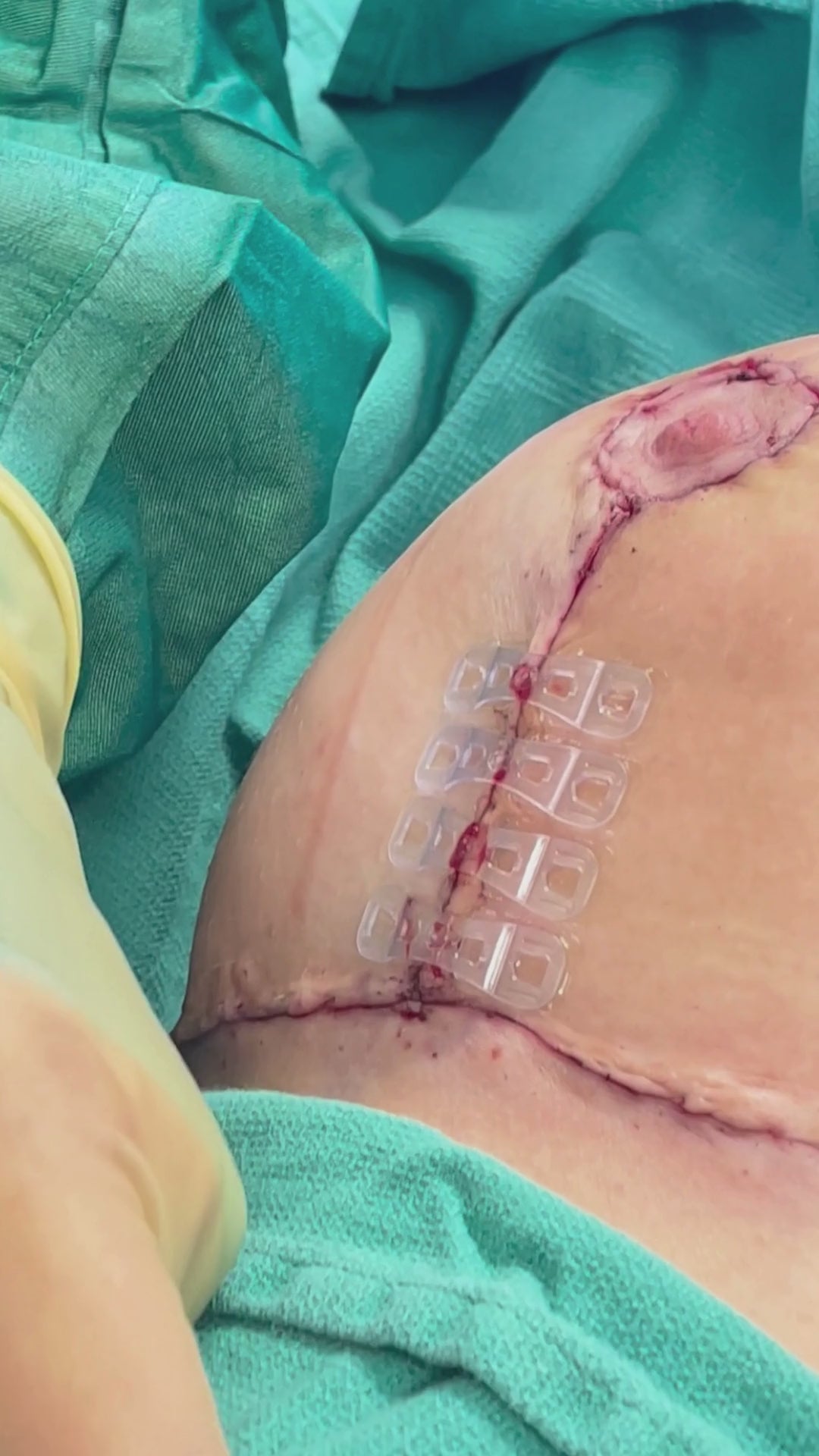 Load video: Plastic surgeon places Brijjit, a final skin closure device, to reduce wound dehiscence, wound breakdown and end with smaller scars in breast surgery.