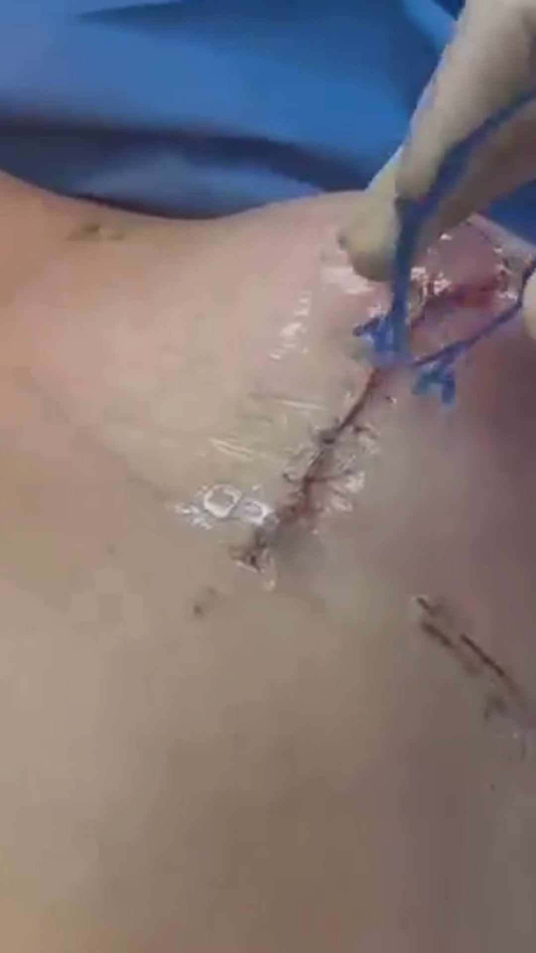Load video: Surgeon uses active tension offloading device, Brijjit, to prevent wound dehiscence, reduce wound breakdown, and leave smaller scars after orthopedic and plastic surgery.