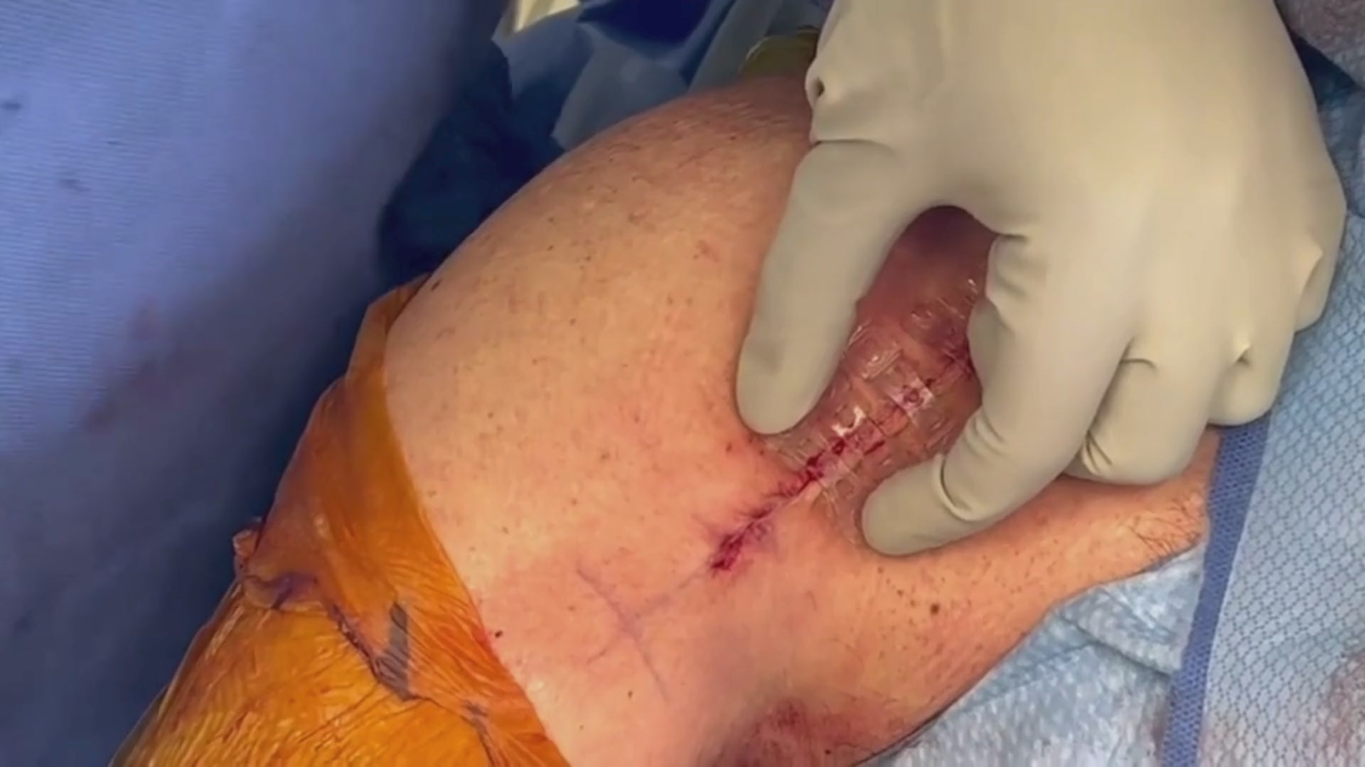 Load video: Surgeon uses active tension offloading device, Brijjit, to prevent wound dehiscence, reduce wound breakdown, and leave smaller scars after orthopedic and plastic surgery.