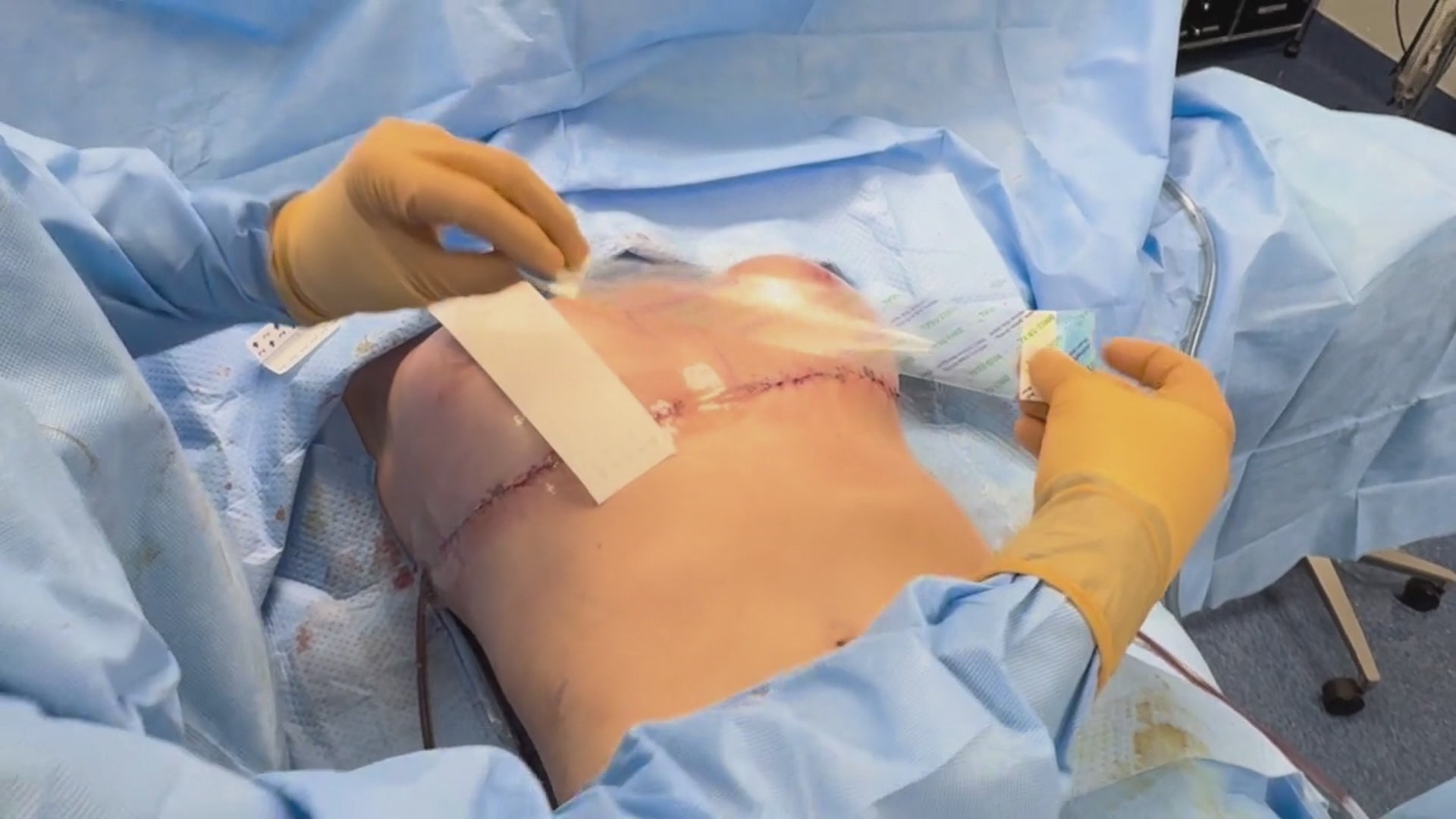 Load video: Plastic surgeon places Brijjit, a final skin closure device, to reduce wound dehiscence, wound breakdown and end with smaller scars in breast surgery.