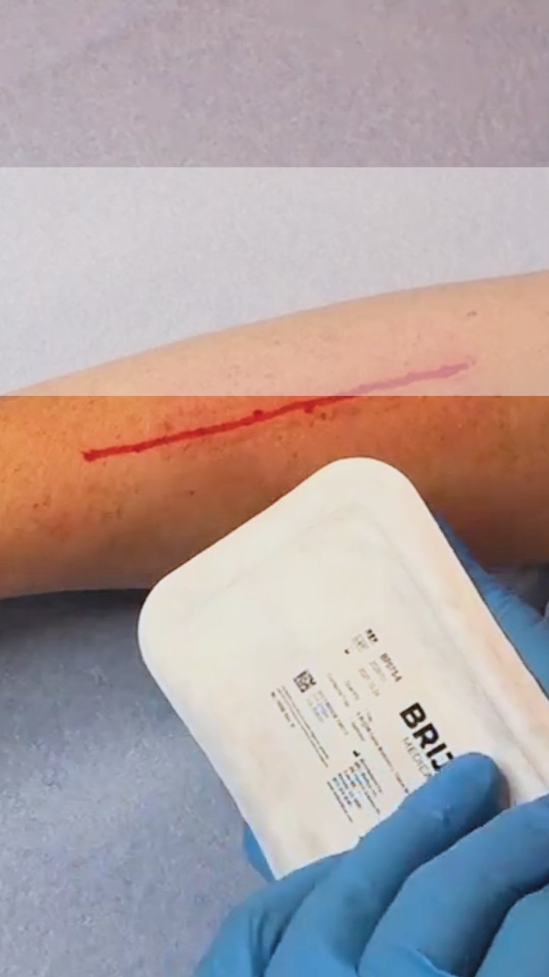 Load video: How to apply Brijjit Force Modulating Tissue Bridges